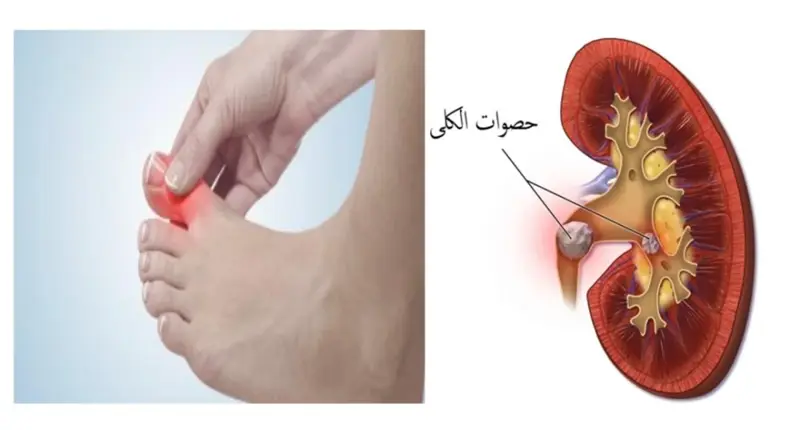 استشاري لـ'اليوم': الوقاية من حصوات الكلى والنقرس تبدأ بالتشخيص الصحيح وتعديل نمط الحياة